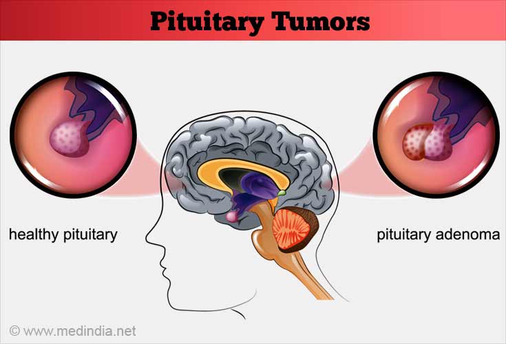Pituitary Tumors Causes Symptoms Diagnosis Treatment