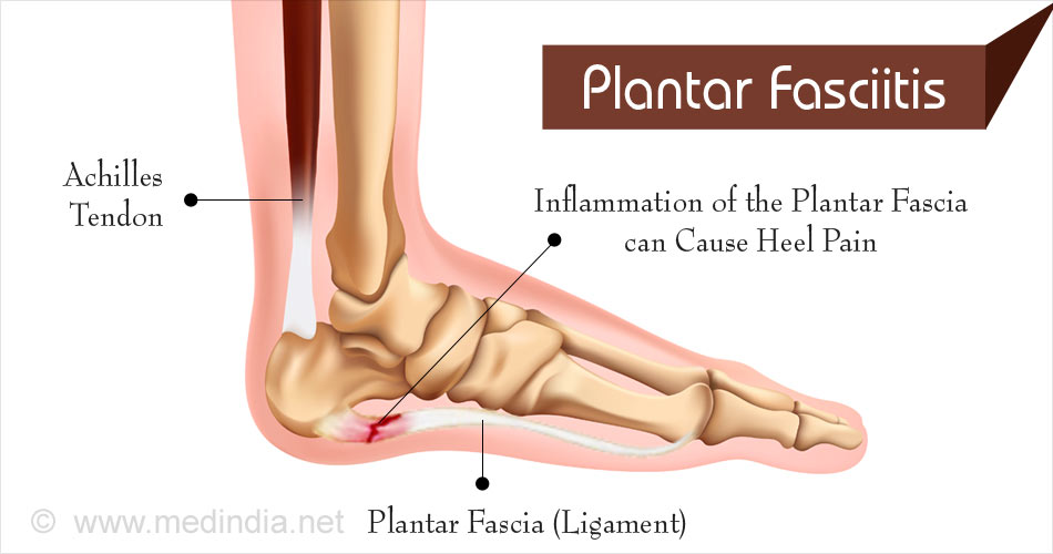 Plantar Fasciitis - Causes, Symptoms, Diagnosis, Treatment