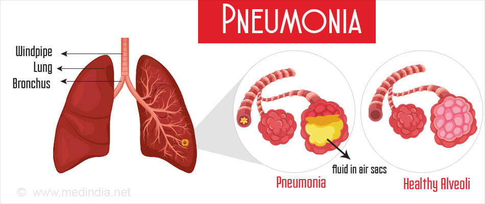 Nursing Paper Example on Pneumonia [SOLVED]