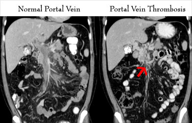 Portal Vein Thrombosis Complications Portal Vein Thrombosis Complications