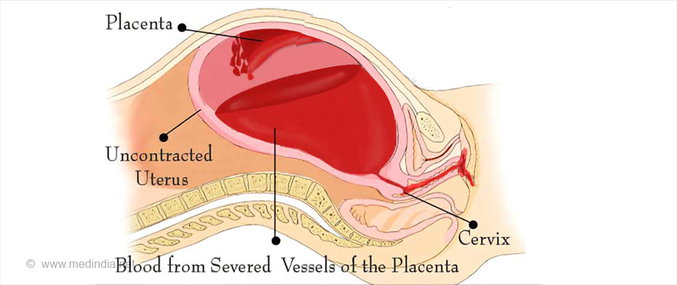Postpartum Hemorrhage Postpartum Hemorrhage