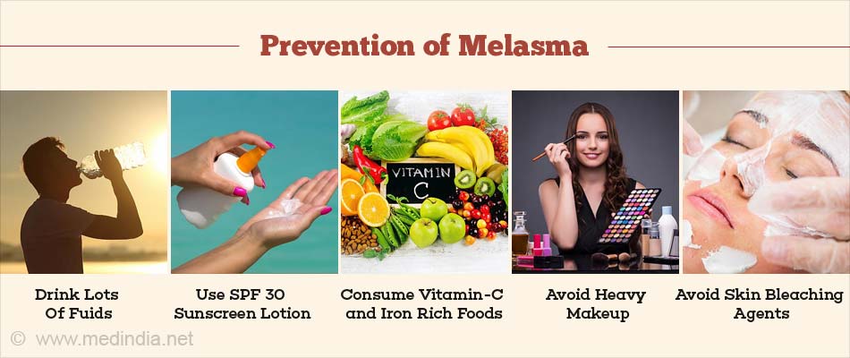 Melasma Causes Symptoms Risk Factors Diagnosis Treatment And Prevention