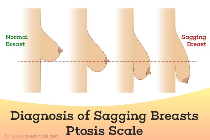 Breast Structure Ways To Prevent Breast Sagging