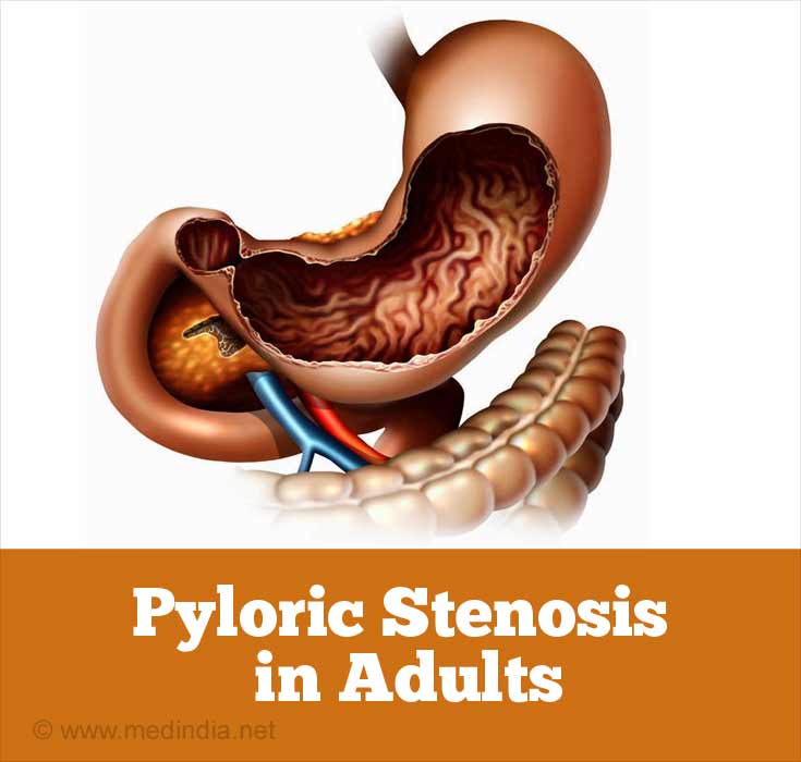 Pyloric Stenosis In Adults Causes Symptoms Signs Diagnosis Treatment