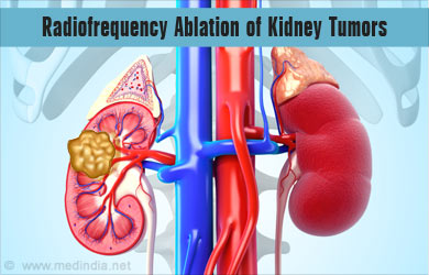 Radiofrequency Ablation of Kidney Tumors Radiofrequency Ablation of Kidney Tumors