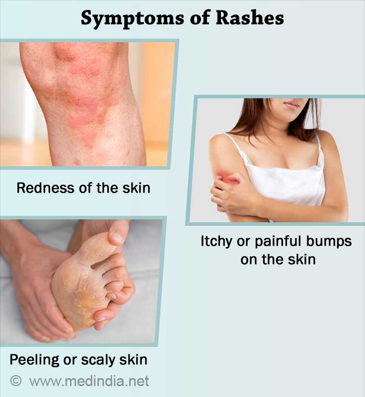Symptoms of Rashes Symptoms of Rashes