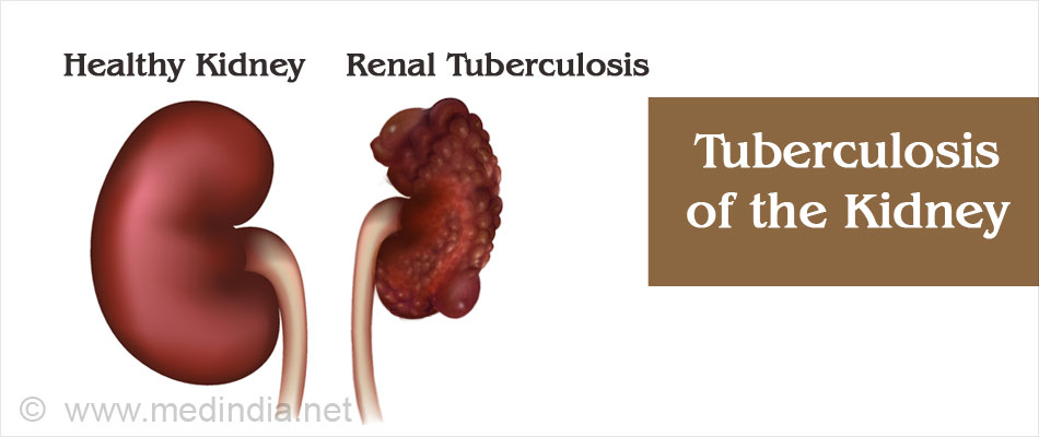 Renal Tuberculosis Renal Tuberculosis