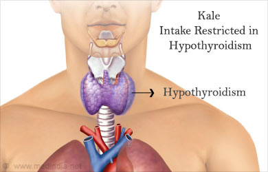 Restrict Intake of Kale in Hypothyroidism Restrict Intake of Kale in Hypothyroidism