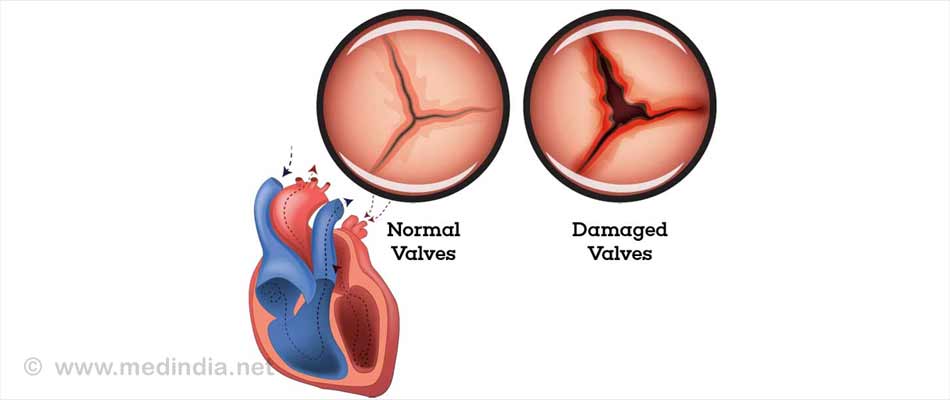 Rheumatic Heart Disease Rheumatic Heart Disease