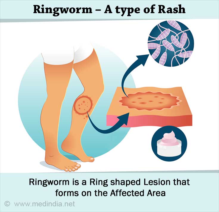 Ringworm Skin Infection Ringworm Skin Infection