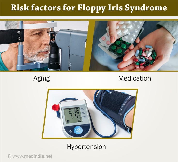 Risk Factors for Floppy Iris Syndrome