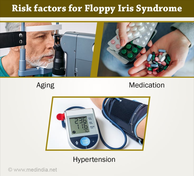 Risk Factors for Floppy Iris Syndrome Risk Factors for Floppy Iris Syndrome