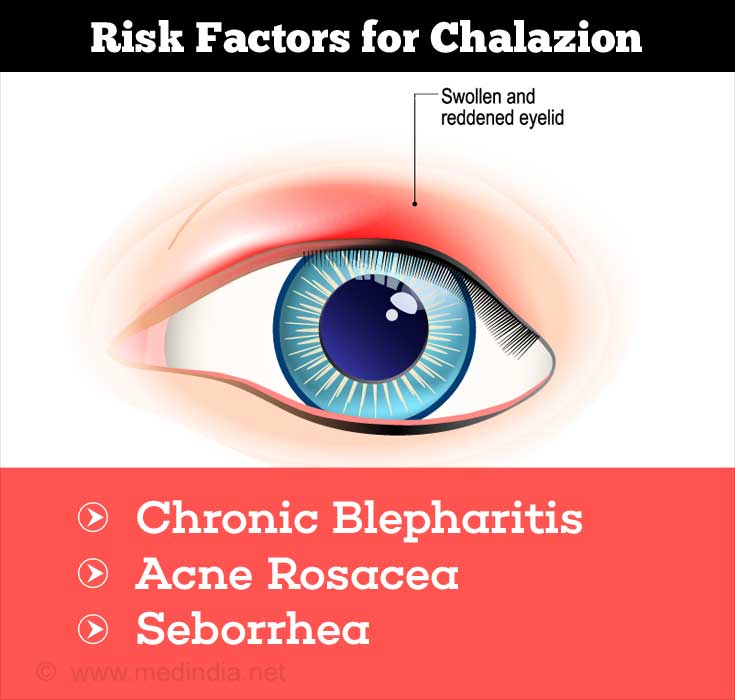 Chalazion (Eyelid Condition) - Causes, Symptoms, Signs, Diagnosis ...