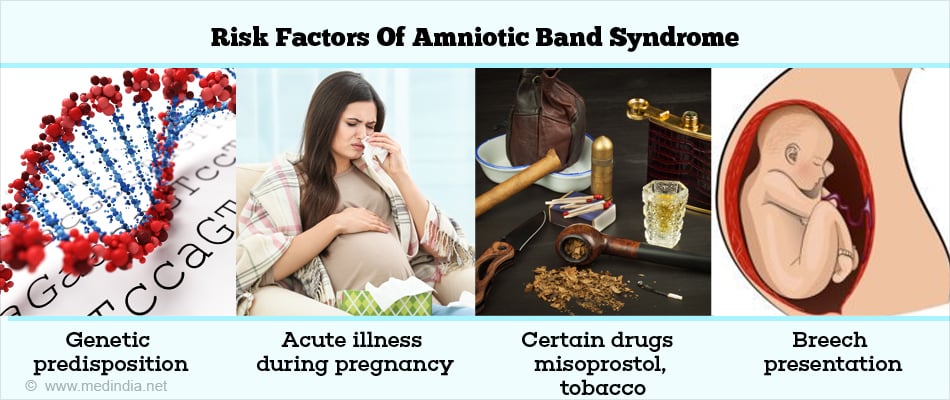 Risk Factors of Amniotic Band Syndrome Risk Factors of Amniotic Band Syndrome