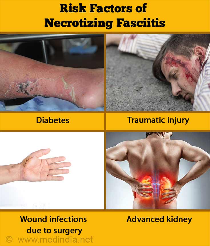 Necrotizing Fasciitis Late Stages 