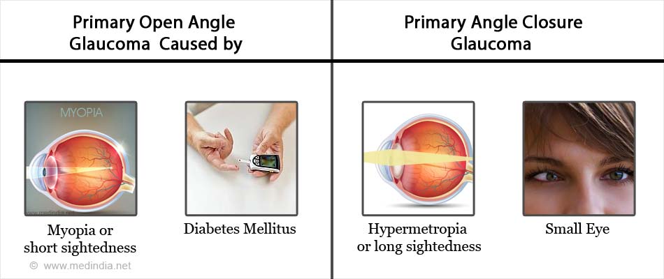 Risk Factors of Primary Open Angle Glaucoma And Primary Angle Closure Glaucoma Risk Factors of Primary Open Angle Glaucoma And Primary Angle Closure Glaucoma