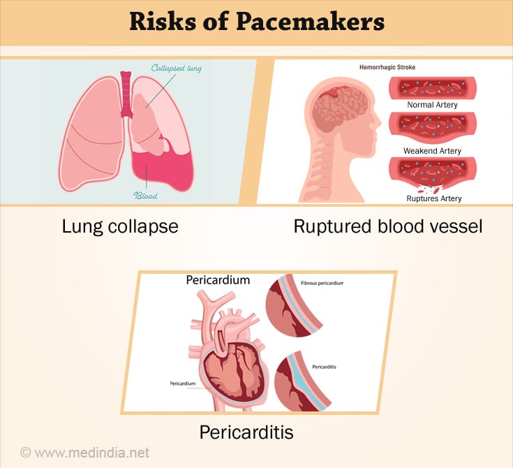 Pacemakers Risks