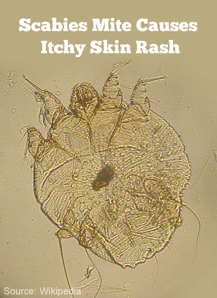 Scabies Mite Causes Itchy Skin Rash Scabies Mite Causes Itchy Skin Rash