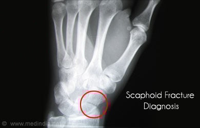 Scaphoid Fracture of The Wrist: Diagnosis Scaphoid Fracture of The Wrist: Diagnosis