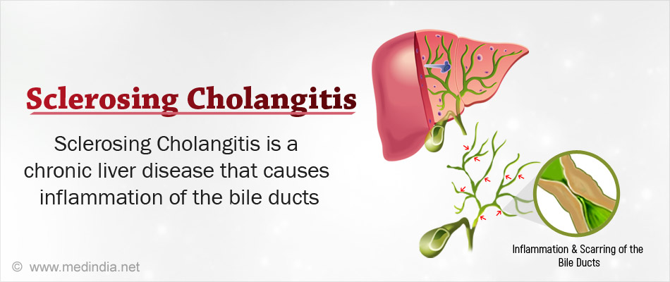 Sclerosing Cholangitis Sclerosing Cholangitis