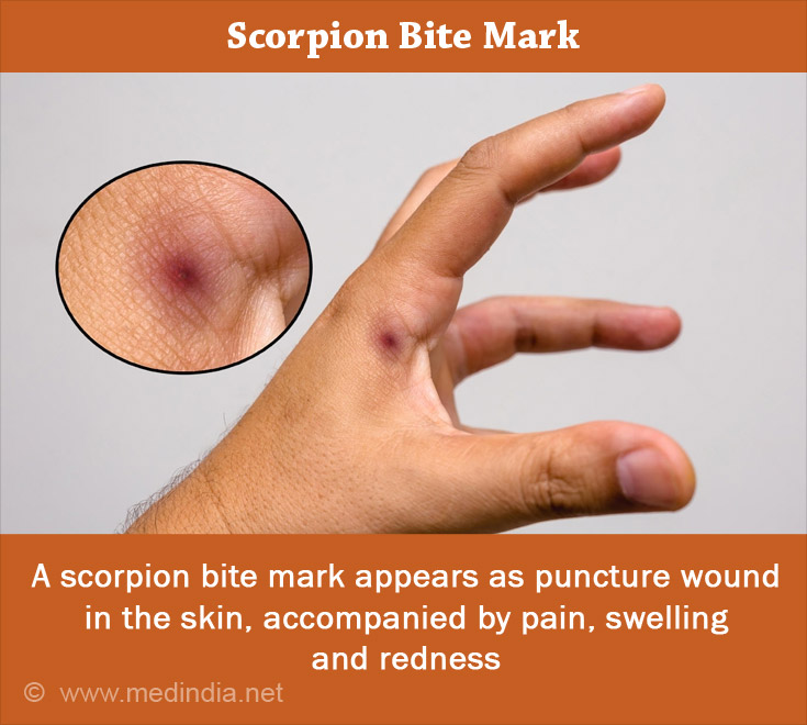 Scorpion Bite Mark