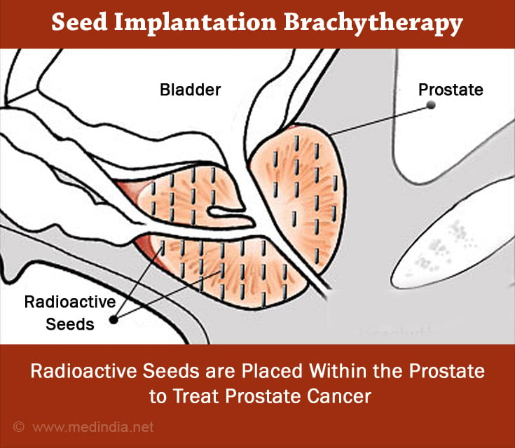 Brachytherapy For Prostate Cancer Doses Side Effects Precautions 2612