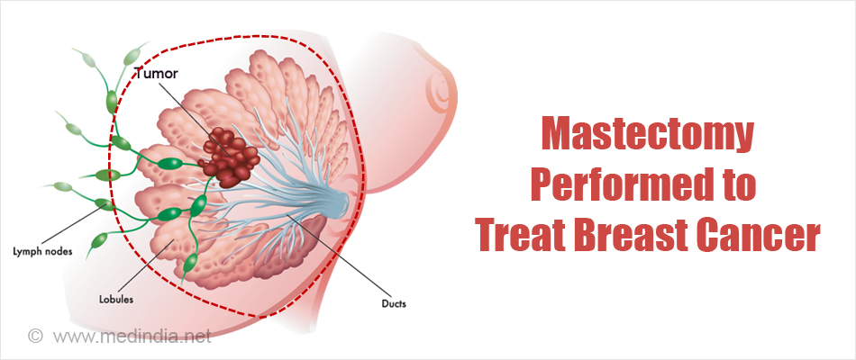 Segmental Mastectomy Performed to Treat Breast Cancer Segmental Mastectomy Performed to Treat Breast Cancer
