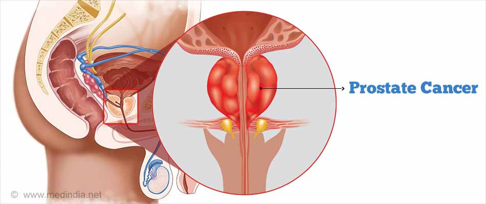Cracking Sexual Health Myths for a Healthy Living: Prostate Cancer Cracking Sexual Health Myths for a Healthy Living: Prostate Cancer