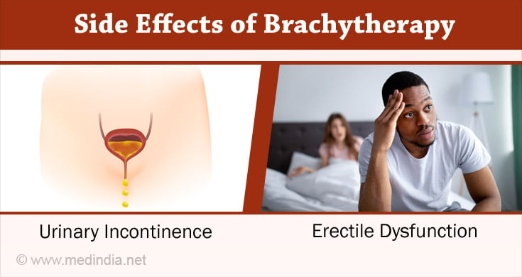 Side Effects of Brachytherapy