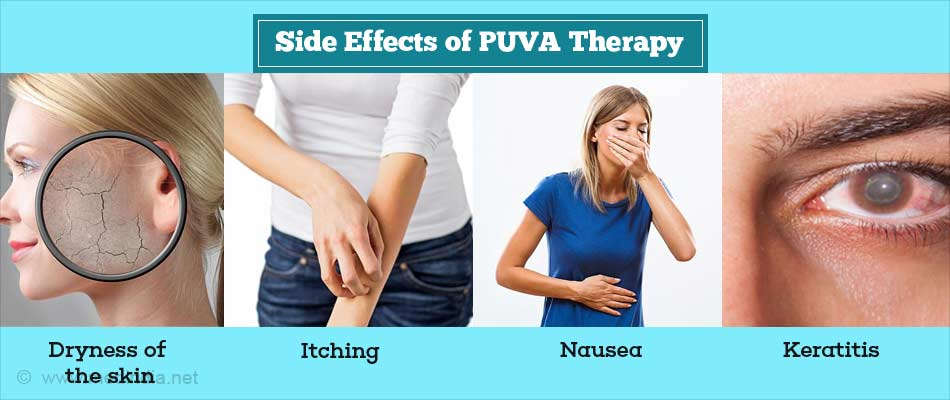 Side Effects of PUVA Therapy Side Effects of PUVA Therapy