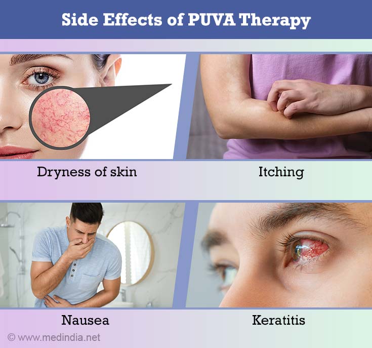 puva-therapy-photochemotherapy-side-effects-health-tips