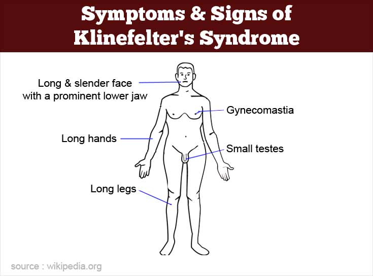 Klinefelters Syndrome Causes Symptoms Diagnosis Treatment