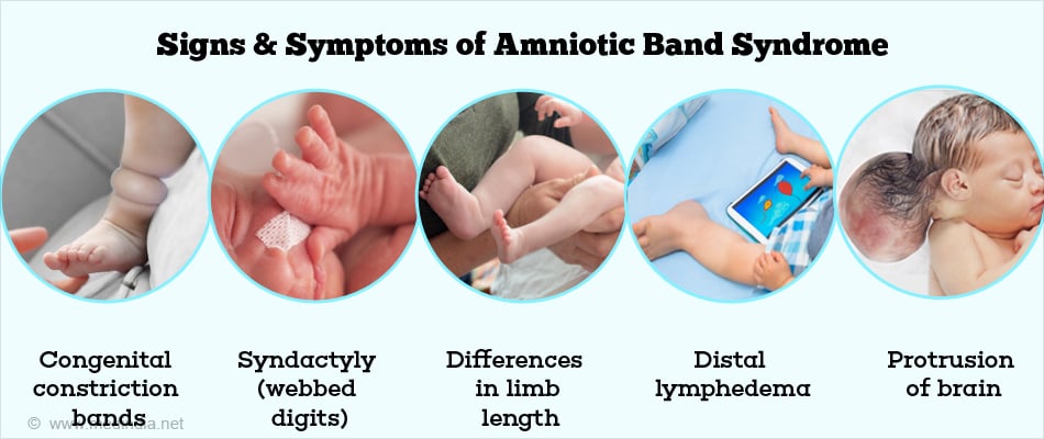 How We Monitor and Treat Amniotic Band Syndrome