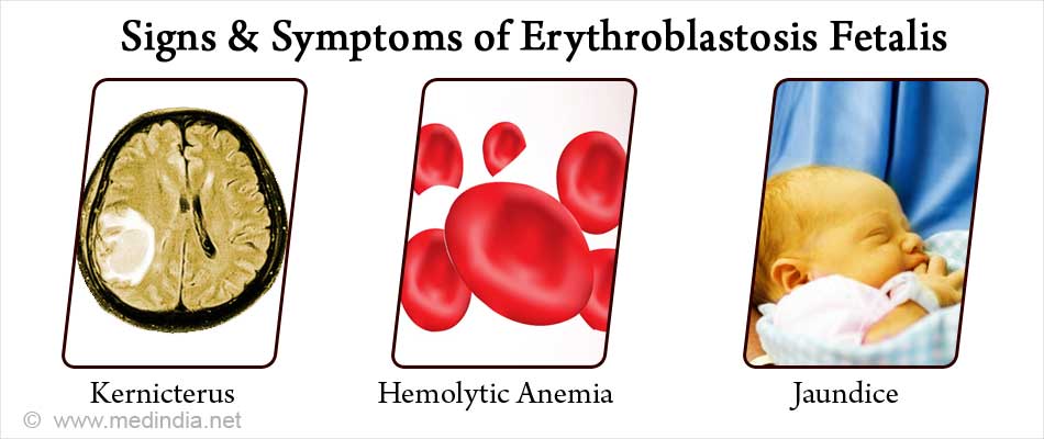 Erythroblastosis Fetalis Causes Symptoms Diagnosis Treatment Prevention