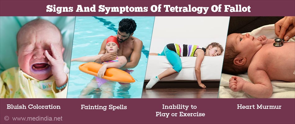 Signs and Symptoms of Tetralogy of Fallot Signs and Symptoms of Tetralogy of Fallot
