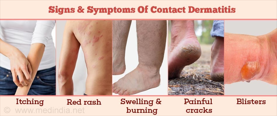 contact dermatitis treatment
