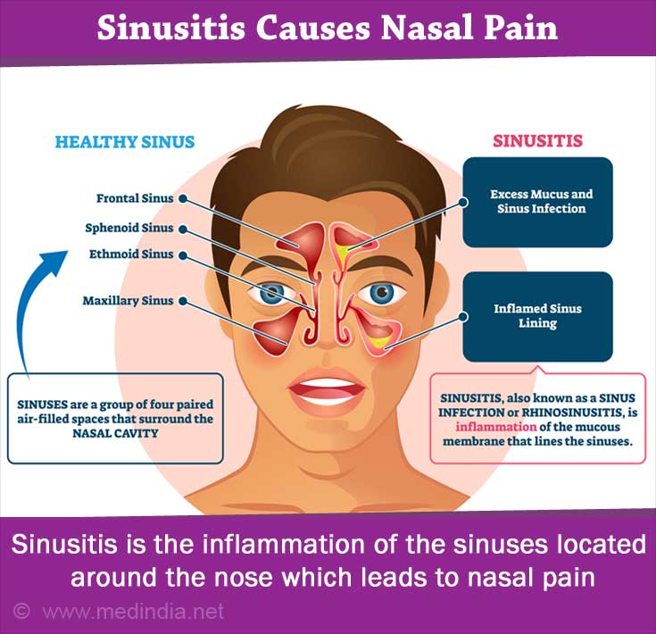 Sinusitis - Types, Causes, Symptoms, Complications and Treatment