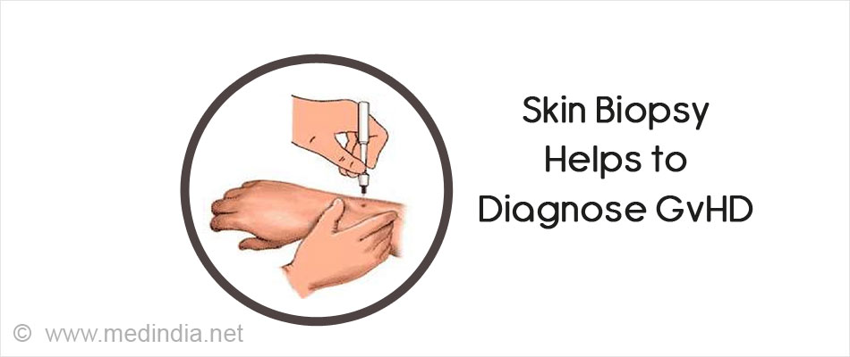 Skin Biopsy Helps to Diagnose GvHD Skin Biopsy Helps to Diagnose GvHD