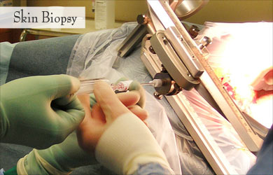 Skin Biopsy for Mucolipidoses Skin Biopsy for Mucolipidoses