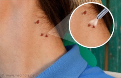 Acrochordon (Skin Tags) at best price in Noida