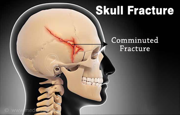 basilar fracture