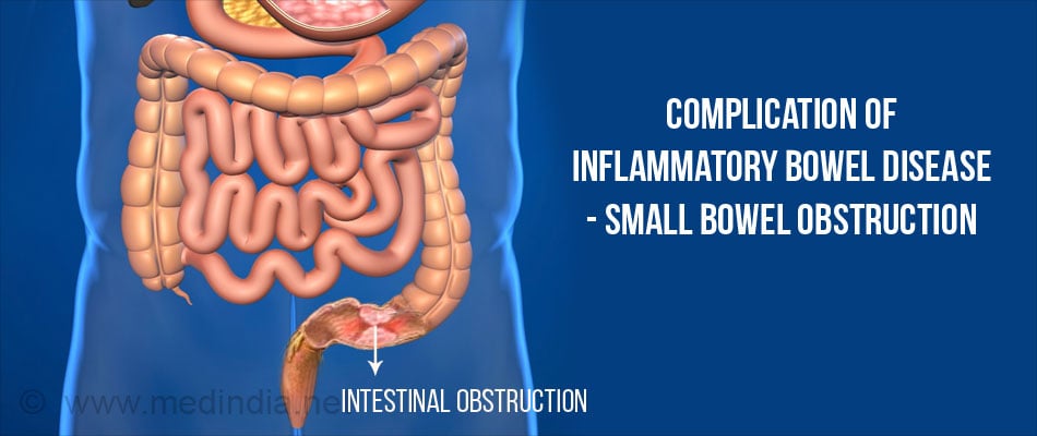 Inflammatory Bowel Disease - Causes, Symptoms, Diagnosis, Treatment ...