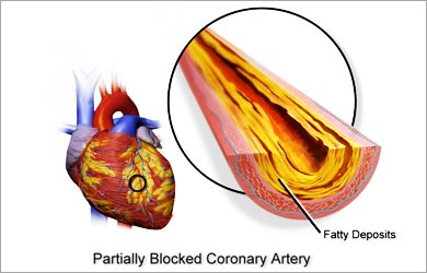Smoking and Cardiovascular Disease: Coronary Heart Disease Smoking and Cardiovascular Disease: Coronary Heart Disease