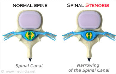 Spinal Injury - Symptom Evaluation