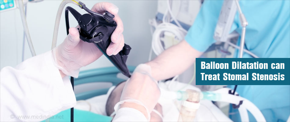 Stomal Stenosis Treatment Endoscopic Dilatation Stomal Stenosis Treatment Endoscopic Dilatation