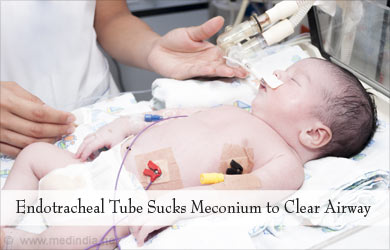 Suction Catheter for Airway Cleaning