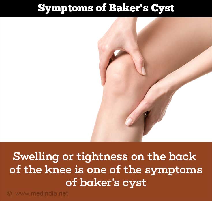 Bakers Cyst Causes Symptoms Diagnosis Treatment 9322