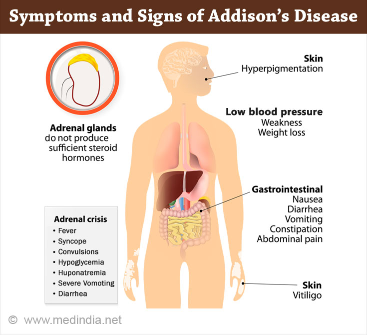 Symptoms and Signs of Addison's Disease