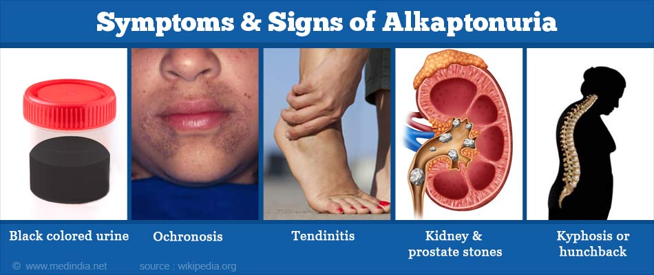 Alkaptonuria (Black Urine Disease) - Causes, Symptoms, Diagnosis, Treatment  and Prognosis