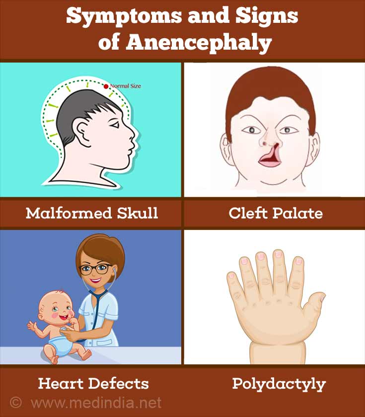 Anencephaly - Causes, Symptoms, Diagnosis and Treatment